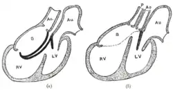 Diagrams to illustrate the transformation of the bulbus cordis. Ao. Truncus arteriosus. Au. Atrium. B. Bulbus cordis. RV. Right ventricle. LV. Left ventricle. P. Pulmonary artery.