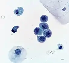 High-grade urothelial carcinoma. A cytologic diagnosis of high-grade urothelial carcinoma requires > 10 cells with high N/C ratio, irregular chromatin pattern and hyperchromatic nuclei (Pap stain).