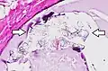 Histopathology of calcium oxalate crystals in a benign breast cyst, H&E stain. In the breast, they can be seen on mammography and are usually benign, but can be associated with lobular carcinoma in situ.