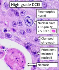 Histopathology of high-grade DCIS. H&E stain.RBC = red blood cell.