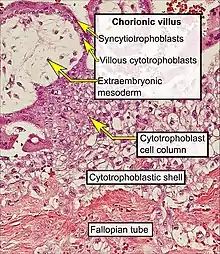 Histopathology of a chorionic villus, in a tubal pregnancy, with labeled cytotrophoblasts and syncytiotrophoblasts.