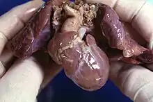 A post-mortem example of an infant heart and lungs, the heart has Hypoplastic Right Heart Syndrome