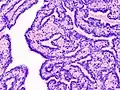 Histopathology of intraductal papilloma of the breast by excisional biopsy. Hematoxylin and eosin stain.