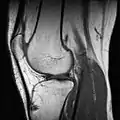 Sagittal MRI of the knee