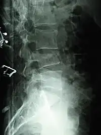 Compression fracture of the fourth lumbar vertebra post falling from a height.