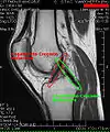 Cruciate ligaments