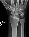 Dislocated lunate