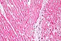 Micrograph showing karyolysis and contraction band necrosis (left of image) and ischemic (nucleated) cardiac myocytes (right of image) in an individual that had a myocardial infarction.