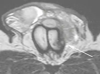 B: Axial T2-weighted turbo spin-echo magnetic resonance imaging scan showing left-sided discontinuity of the tunica albuginea (arrow), secondary to fracture.