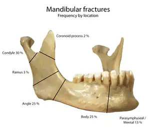 Frequency of mandibular fractures by location.