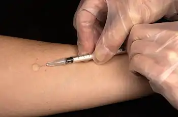 Mantoux tuberculin skin test