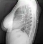 X-ray showing lipoma