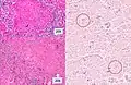 Histopathology, showing epithelioid granulomas with multinucleated giant cells and acid-fast bacilli