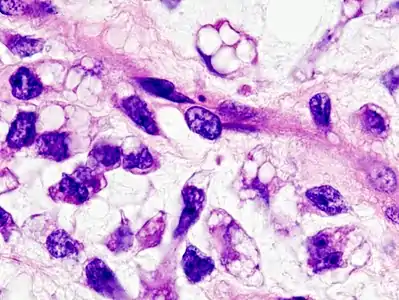 Fig. 4 Higher-power micrograph of myxoid liposarcoma tumor