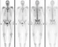 Normal bone scan in a person with osteopoikilosis