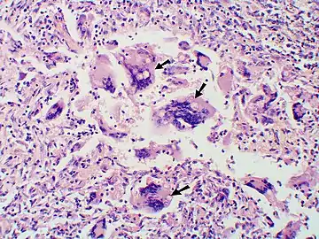 Large yeast-like fungi seen within giant cells at arrows.