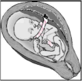 Nuchal cord - free sliding