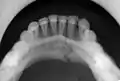 occlusal radiograph of a mandibular parasymphysis fracture