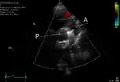 An echocardiogram of a coiled PDA: One can see the aortic arch, the pulmonary artery, and the coil between them.