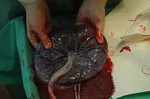 Photo of a placenta expelled after labor. Failure of complete expulsion of placenta can hinder the onset of lactation.