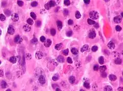 Micrograph of a plasmacytoma, H&E stain