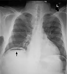 Free air under diaphragm seen on abdominal X-ray.