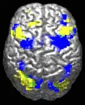 A human brain viewed from above. About 10% is highlighted in yellow and 10% in blue. There is a tiny green region (~0.5%) where they overlap.