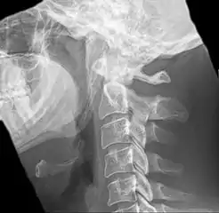 Radiograph, lateral view showing joint-like formation in ossified stylohyoid ligament