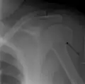 Proximal humerus fracture