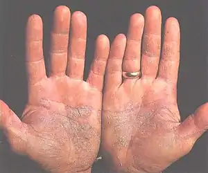 Psoriasis of the palms