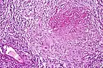 Pulmonary tuberculosis featuring necrotizing granulomas, high power view, H&E stain.