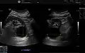 Renal cyst as seen on abdominal ultrasound