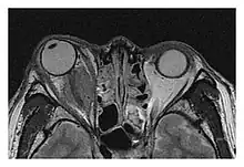 Right optic disc lesion in IgG4-ROD