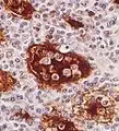 Emperipolesis in Rosai-Dorfman disease highlighted by S-100 staining.