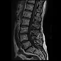 MRI lumbar spine with degeneration, post-hemilaminectomy L4-5 (sagittal T1 FSE)