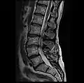 MRI lumbar spine with degeneration, post-hemilaminectomy L4-5 (sagittal T2 FRFSE)