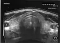 Fig. 3Ultrasonic: Cross section of the thyroid