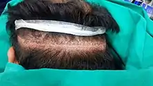 Scalp Micro pigmentation