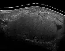 Ultrasonography of a liposarcoma mimicking lipoma. A homogeneous hypoechoic mass presenting with the same appearance of lipoma. It was clinically distinguished by having rapid growth.