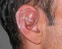 A seroma causing inflammation in part of the outer ear above the external auditory meatus.