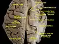 Human brain dissection, showing the thalamus.