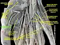 Flexor pollicis brevis muscle