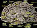 Medial surface of cerebral hemisphere.Medial view.Deep dissection.