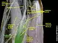 Gracilis muscle