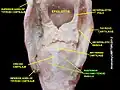 Posterior cricoarytenoid muscle