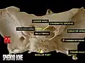 Sphenoid bone superior view