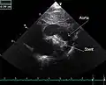 An echocardiogram of a stented persisting ductus arteriosus: One can see the aortic arch and the stent leaving. The pulmonary artery is not seen.