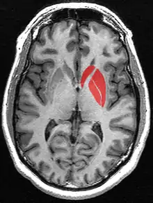 This is a transverse section of the striatum from a structural MR image. The striatum includes the caudate nucleus (top) and putamen (right) and the globus pallidus (left).