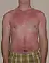 A sunburn is a typical first-degree burn.