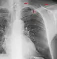 The inferior skin folds of the supraclavicular fossa may give the impression of a periosteal reaction of the clavicle